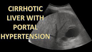 CIRRHOTIC LIVER WITH PORTAL HYPERTENSION ON ULTRASOUND  WITH PRACTICAL TIP [upl. by Aicaca]