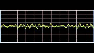 EpsteinBarr  Rife Frequencies [upl. by Cathleen]