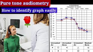 Pure tone Audiometry Graph 📊 🔴conductive hearing loss Sensorineural hearing loss Mixed hearing [upl. by Rimahs]