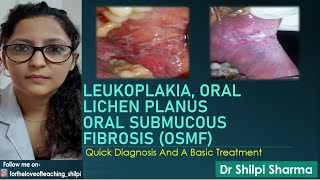 Quick Diagnosis And Basic Treatment of Leukoplakia Lichen Planus and Oral Submucous Fibrosis OSMF [upl. by Asa]