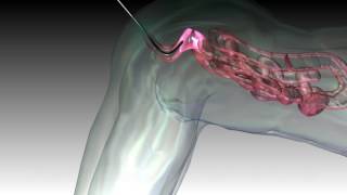 colonoscopy colon colonoscope endoscope 3d medical animation company studio 3d visualization healthc [upl. by Chalmer]