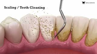 Scaling  Teeth Cleaning  Teeth Scaling  Scaling And Polishing  Dental Aesthetics [upl. by Kerril641]