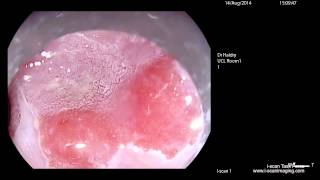 Intramucosal cancer in Barretts Oesophagus Zoom IMC [upl. by Ahsena838]