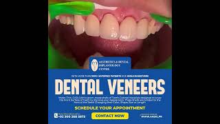 Aadic  Veneers Case dentist dentalclinic cosmeticdentistry veneers [upl. by Shirlene]