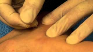 Dry needling for treatment of plantar fasciitis [upl. by Corvin]