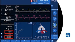 Volumetric Capnography How to set PEEP according to VCO2 [upl. by Nedyaj]