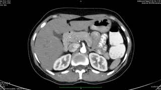 TMT Pancreatic Imaging by Dr Ankur Shah Protocols [upl. by Ayetal]