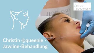 Jawline  Behandlung  Kinnlinie unterspritzen [upl. by Kcirdde]