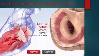 Animasi Stenosis Katup Mitral [upl. by Helsa]