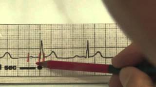 EKG für Pflege Teil 24  AVBlock 2 Grades TYP 2 interpretieren [upl. by Leach]