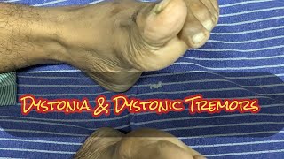 Dystonia Dystonic Tremors Extrapyramidal manifestations STRIATAL TOE [upl. by Quinn]