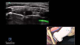 How To Ultrasound Guided Interscalene Nerve Block 3D Video [upl. by Lorant]