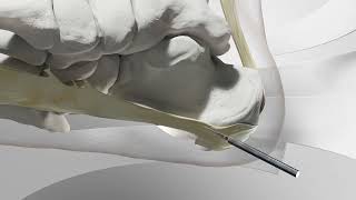 Minimally Invasive Plantar Fasciitis Heel Spur Surgery [upl. by Noyart]