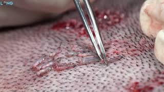 Hair Transplant Graft Extraction Process ll Long Hair Center [upl. by Erminie]