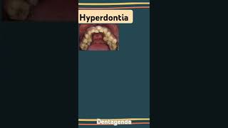 Hyperdontia [upl. by Zehcnas]