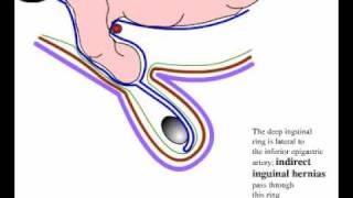 Direct and indirect inguinal hernia [upl. by Nuahsed]