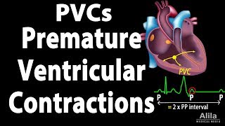 Premature Ventricular Contractions PVCs Animation [upl. by Nyvlem]