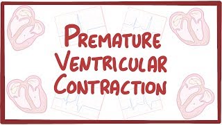 Premature Ventricular Contraction  causes symptoms diagnosis treatment pathology [upl. by Mattie382]