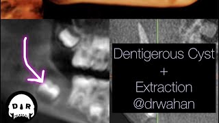 Dentigerous Cyst Removal with Extraction of Involved Impacted Molar drwahan [upl. by Leahcimed]