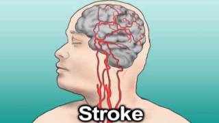 Hypertension and Stroke Health Tip [upl. by Prevot659]