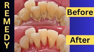 Naturally Remove Dental Plaque At Home Easy Tips And Tricks [upl. by Nessie]