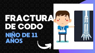 CAÍDA Y FRACTURA DE BRAZO NIÑO DE 11 AÑOS Fracturas en tallo verde [upl. by Lenad122]