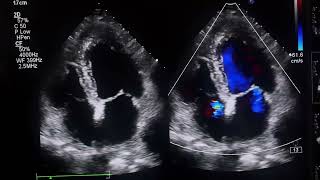 APICAL HYPERTROPHIC CARDIOMYOPATHYApical HCM heart hypertrophy [upl. by Editha]