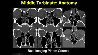 New update  imaging of Paranasal sinuses and anterior skull base [upl. by Snehpets]