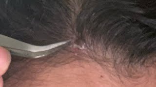 Tweezing out large scalp scabs [upl. by Muffin]