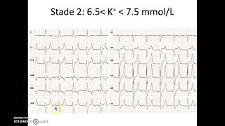 Hyperkaliémie signes ECG [upl. by Hussey653]