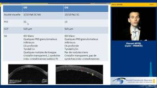 Hypertonie et uvéites  cas clinique Florent Aptel [upl. by Romeon534]