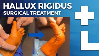 Hallux rigidus surgery  cheilectomy Moberg osteotomy  Dworska hospital® [upl. by Enrichetta]