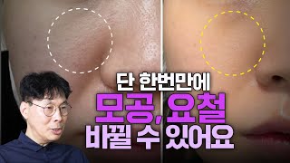 단 한번으로 피부과 안가고 모공요철 좋아진 후기   당신이 꼭 봐야할 확실한 MTS 피부관리 모공축소ㅣMTS전도사 [upl. by Nivlad]