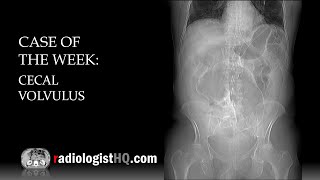 Case of the Week Cecal Volvulus Xray amp CT [upl. by Lokim]