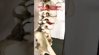 L⁴L⁵L⁵S¹ Disc problem discpain backpain shorts trending backpaintreatment [upl. by Ailegra]