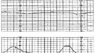 16 Intrapartum Fetal Monitoring [upl. by Aleen]