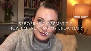 Eyebrow Hair Loss  Seborrheic Dermatitis  Julene Beeson [upl. by Siletotsira]