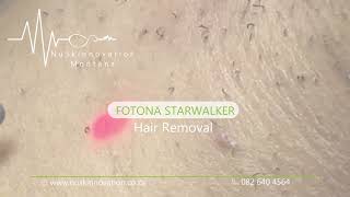 Fotona StarWalker Hair Removal [upl. by Ahsenwahs]