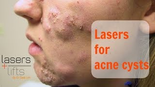 Treating acne cysts [upl. by Biebel]