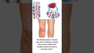 quotUnderstanding Varicose Veins Why Do Veins Dilatequot [upl. by Odnala]