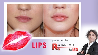 LIP Injections Quick Vid with Dr Rajani [upl. by Aman]