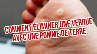 Comment Éliminer une Verrue avec une Pomme de Terre [upl. by Doowrehs106]