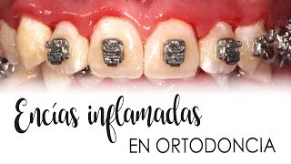 ENCÍAS INFLAMADAS CON ORTODONCIA  CAUSAS Y TRATAMIENTO [upl. by Friedly]