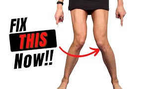 How To Fix Knock Knees With Exercise [upl. by Burack514]