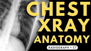 Chest Xray Anatomy  Radiology anatomy part 1 prep  How to interpret a chest Xray [upl. by Kieryt547]