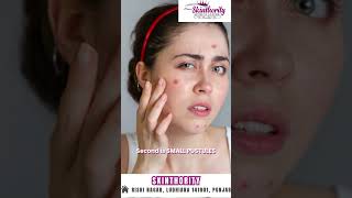 different types of acne skincare glowingskin skin healthyskin [upl. by Buckels]