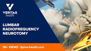 Lumbar Radiofrequency Neurotomy [upl. by Marilla]