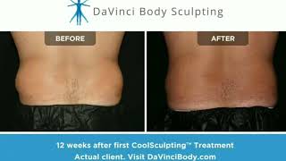 Does CoolSculpting Work  Real Love Handle Results [upl. by Noirrad]