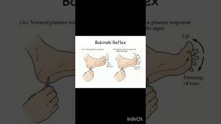 Babinski reflex viralshort medicaleducation humanbody allaboutnorcet norcetstudytips motiv [upl. by Nicole]