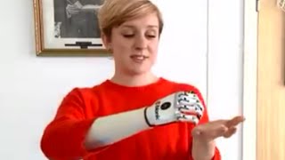 bionic hand UK user receives ‘world’s most lifelike’ bionic hand [upl. by Erodeht46]